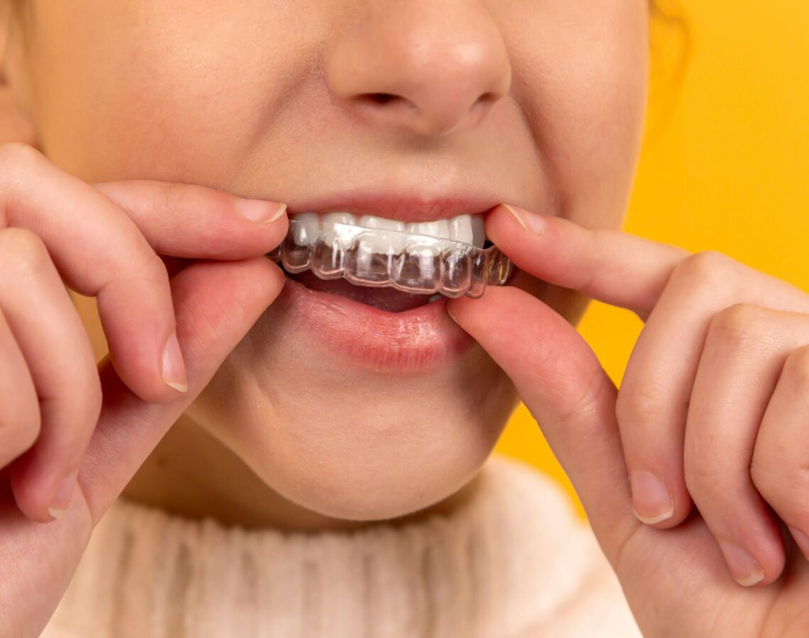 Scopri la guida completa per conoscere il mondo degli apparecchi ortodontici dedicati ai bambini.